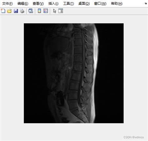 ＜matlab医学图像处理1＞dicom图像读取与显示用matlab读取和显示待处理的医学图像并显示影像信息 Csdn博客
