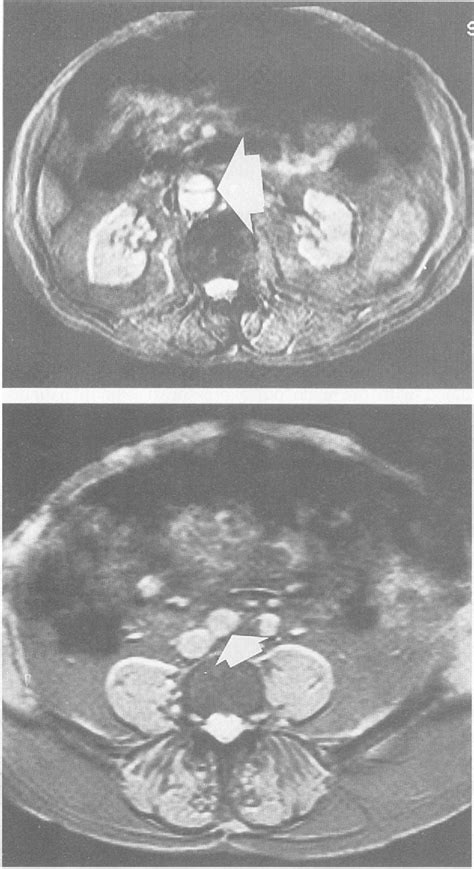 Figure From Hepatotoxic Reaction To Chloroquine Phosphate In A