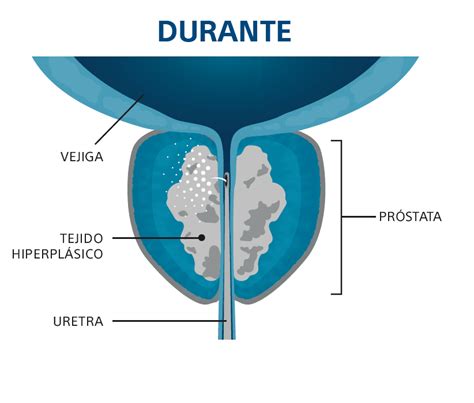 Rezum Para El Tratamiento M Nimamente Invasivo De La Hbp Centro Gil