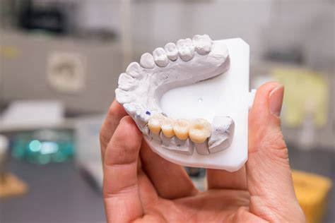 ¿qué Es Un Puente Dental Fijo Top Dental