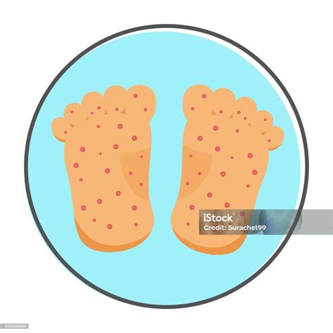 Hand Foot And Mouth Disease Symptoms Stock Illustration - Download Image Now - Care, Cold And ...