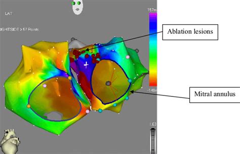 Electroanatomic Map Of The Right And The Left Atrial Chambers Of A