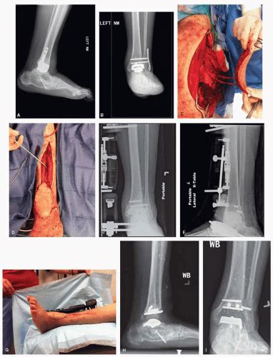 Aseptic Loosening Musculoskeletal Key