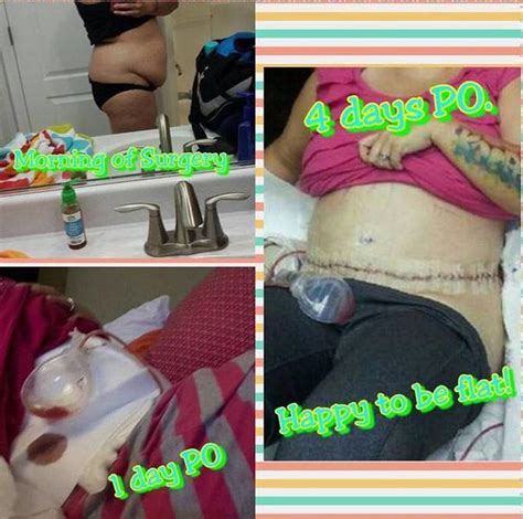 Gallery of tummy tuck before and after photos » Tummy Tuck: Prices ...