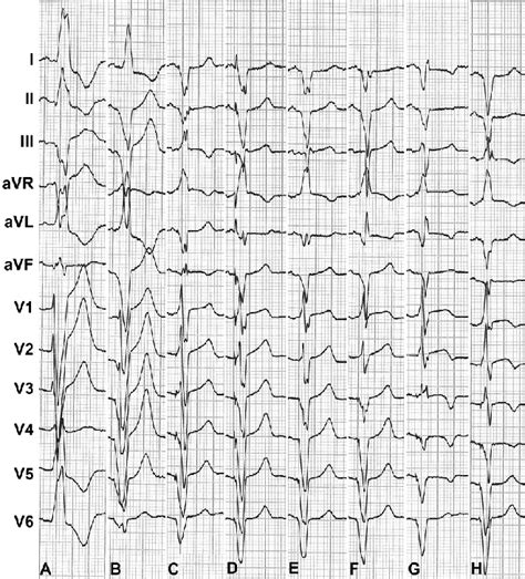 QRS Morphology As A Response To Different Configurations Of