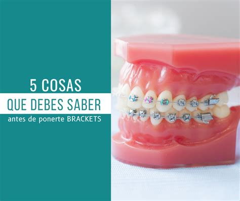 5 Cosas Que Debes Saber Antes De Ponerte Brackets 2021 Ortodent Arce