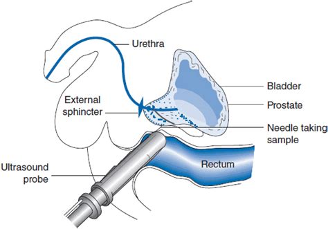 Prostate Biopsy Map