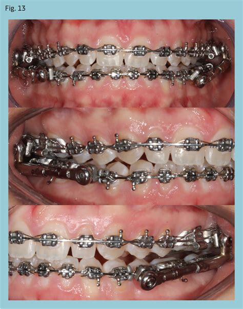 Simplified Correction Of Class Ii Using Powerscope By Alexandre Moro Phd Dds Ms Orthotown