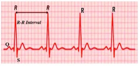 An Ecg Waveform Showing The Qrs Complex And Rr Interval Download Scientific Diagram