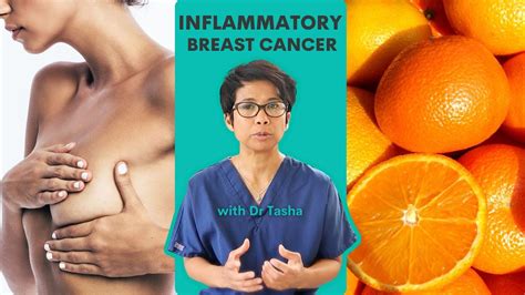 A Rare Type Of Cancer Inflammatory Breast Cancer With Dr Tasha Youtube