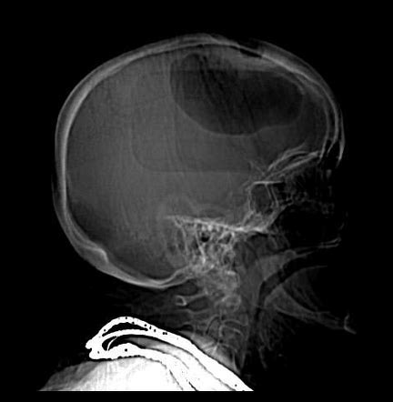 Pneumocephalus Radiology Case Radiopaedia Org