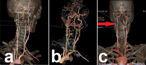 Surgicoanatomical Aspect In Vascular Variations Of The V3 Segment Of Vertebral Artery As A Risk