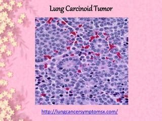 Lung carcinoid tumor | PPT