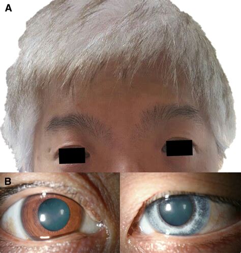 A Novel Pax3 Mutation In A Korean Patient With Waardenburg Syndrome Type 1 And Unilateral Branch