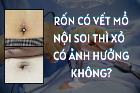 Xỏ Khuyên Rốn ảnh Hưởng đến Vết Mổ Nội Soi Trước đó Không