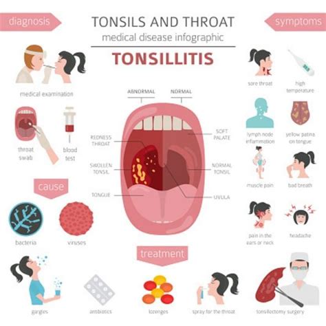 Can you catch tonsillitis? Signs and symptoms of infection explained ...