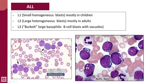 Hematology 2 U2 L31 Fab Classification Of All Subtypes 1 Youtube