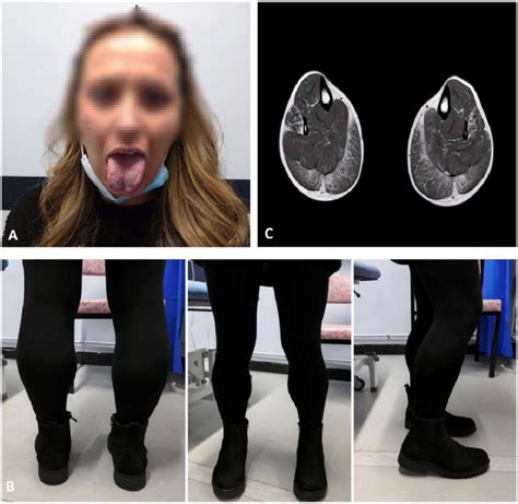 Key features of limb girdle muscular dystrophy type R9/2I (FKRP ...