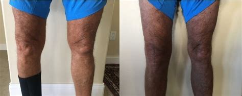 Before And After 4 Months After Total Knee Replacement Surgery Total Knee Replacement Knee