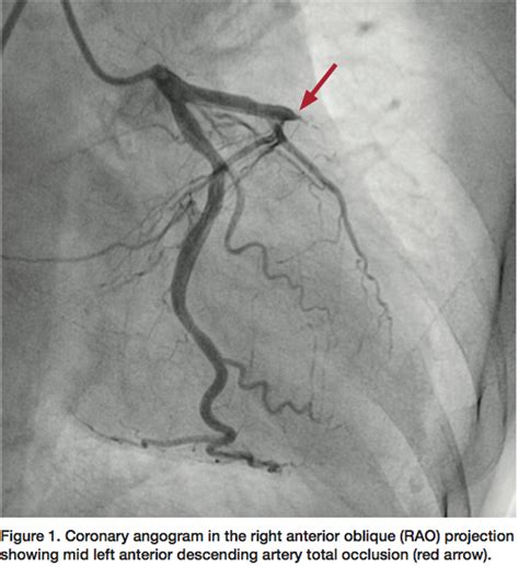 Hyperdominant Left Anterior Descending Artery Continuing As Posterior