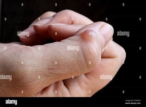 Ganglion Cyst Synovial Cyst Disease On The Thumb Of A Womans Hand