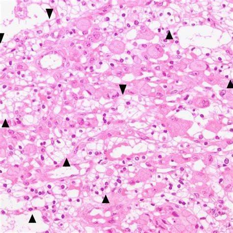 Figure1 Gastric Signet Ring Cell Carcinoma Admixed With A