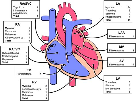 Cardiac Tumours Diagnosis And Management Heart