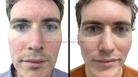 Rosacea Chicago Cosmetic Surgery And Dermatology