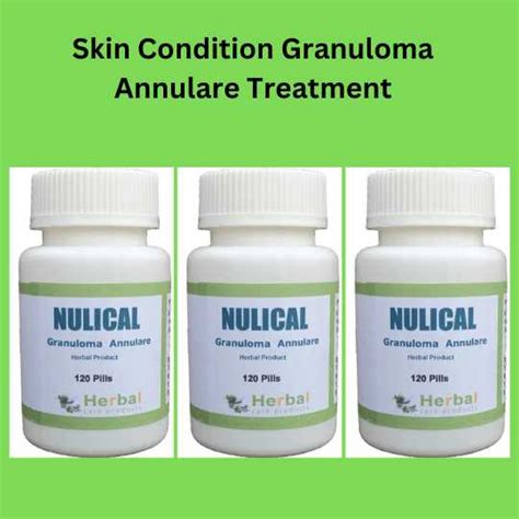 Skin Condition Granuloma Annulare Treatment