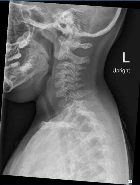 Croup X Ray