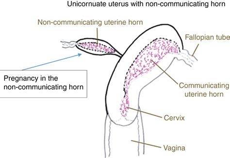 Uterine Rupture Of A Non Communicating Rudimentary Horn Pregnancy With