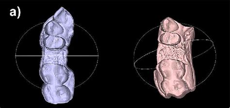 Pdf Dimensional Ridge Alterations And Histomorphometric Analysis