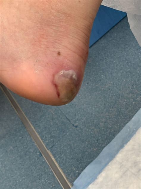 Ampollas en los pies durante el Camino de Santiago Cómo curarlas