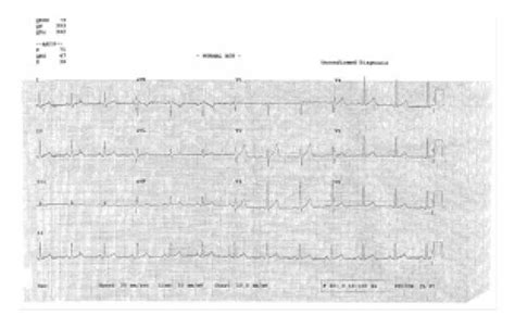 A Baseline Ecg Of The Patient B Ecg Showing Ventricular Download Scientific Diagram