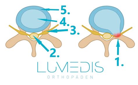 Bandscheibenvorwölbung der LWS Lumedis Bandscheibenspezialisten