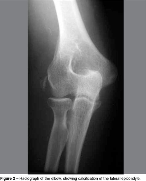 Lateral Epicondylitis Xray