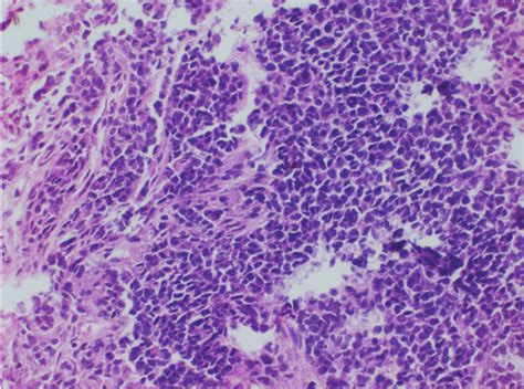 CD99 Stain Shows Diffuse Membrane Positivity IHC 200 Figure 3