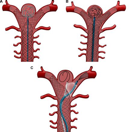 Stent Assisted Coiling Of Cerebral Aneurysms Using The Y Stenting