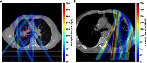 Frontiers Dose Rate And Dose Robustness For Proton Transmission Flash Rt Treatment In Lung Cancer