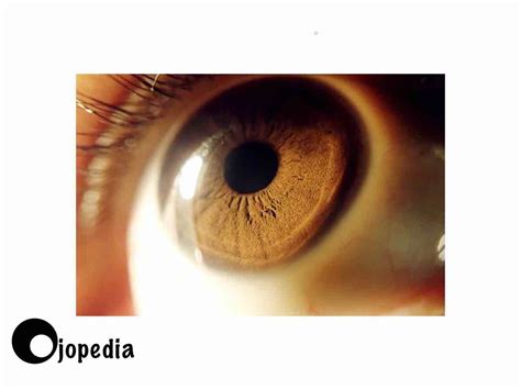 Fotos Del Iris Del Ojo En Ojopedia