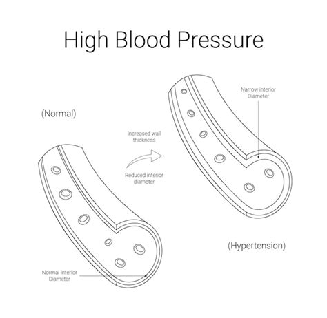 premium vector high blood pressure medical design   illustration