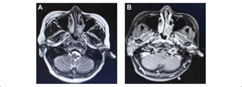 A And B An Mri Of The Paranasal Sinus Shows A Mass In The Left Nasal