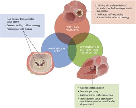 Severe Mitral Annular Calcification Multimodality Imaging For