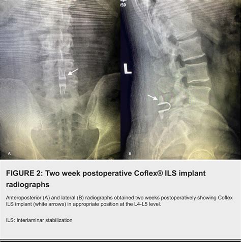 Figure 1 From Lumbar Facet Joint Cyst Treated With Decompression And