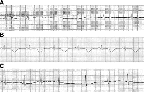 Electrocardiography In The Lead Ii Rhythm Strip A Before Induction Download Scientific