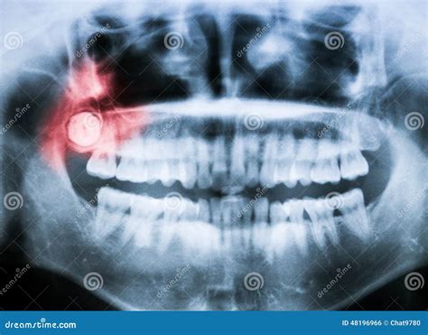 Closeup X Ray Of Impacted Wisdom Tooth Stock Photo Image Of Bone