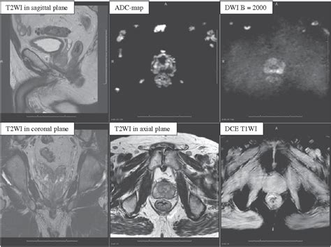 Figure 1 From Biparametric Versus Multiparametric Mri In The Diagnosis