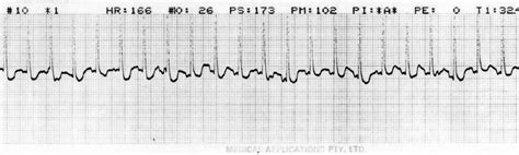 An Ecg Rhythm Strip Demonstrating Multifocal Atrial Tachycardia Heart