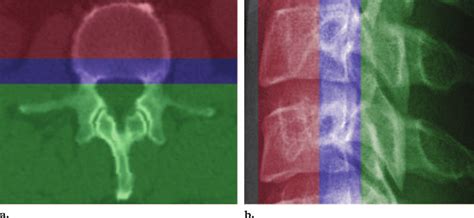 The Three Columns Of The Spine Axial Ct Image A And Lateral