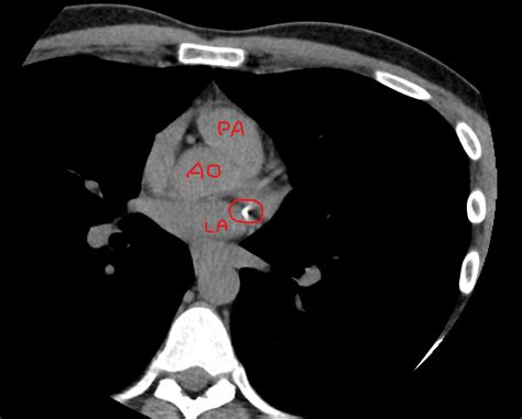 How Common Are Inaccurate Coronary Artery Calcium Scans The